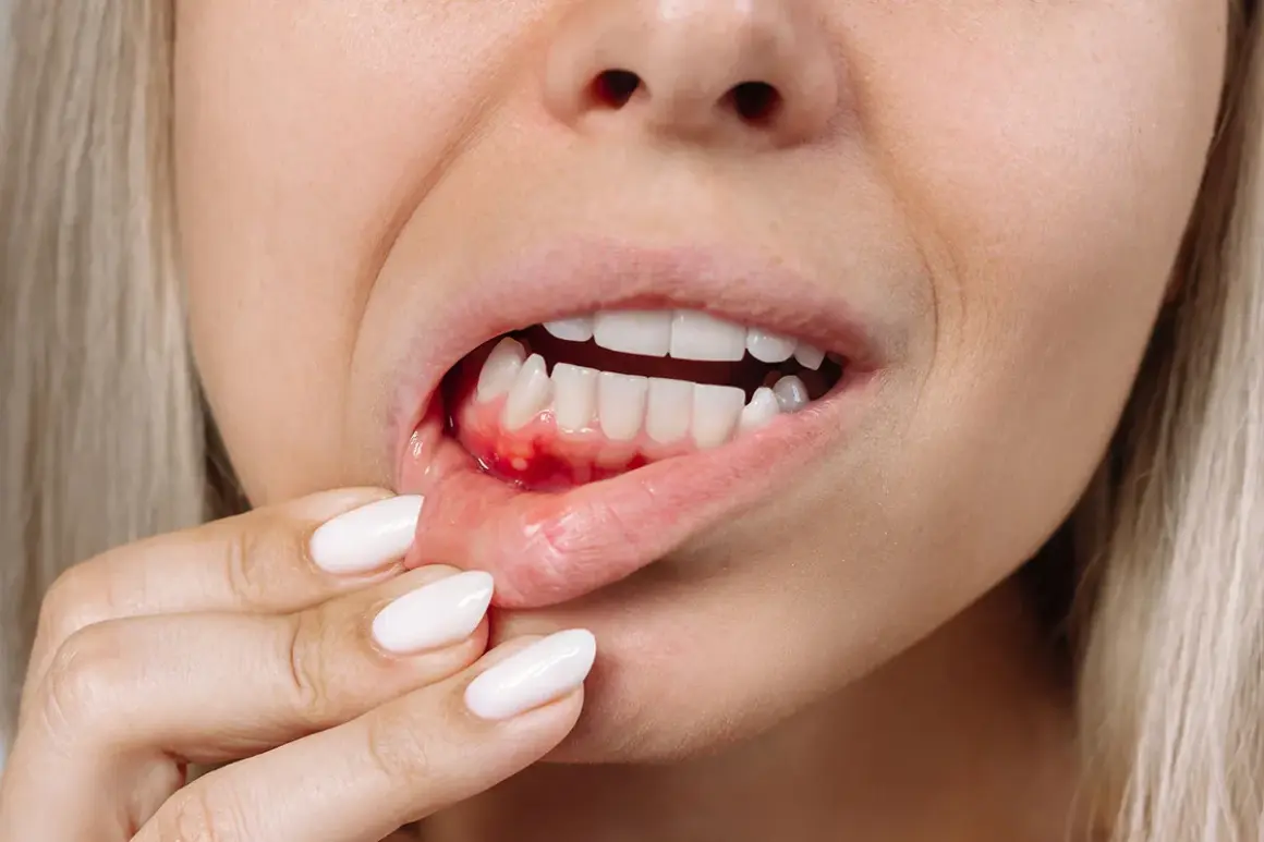 Una persona se toca la encía inflamada y con sangrado dental, mostrando los dientes blancos.