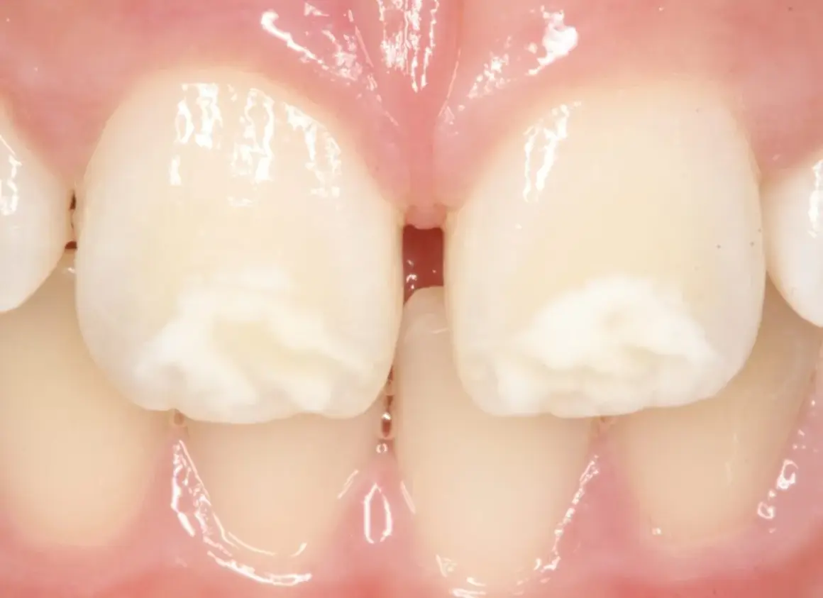 Manchas blancas en las muelas, que no son caries, se ven en los dientes frontales.