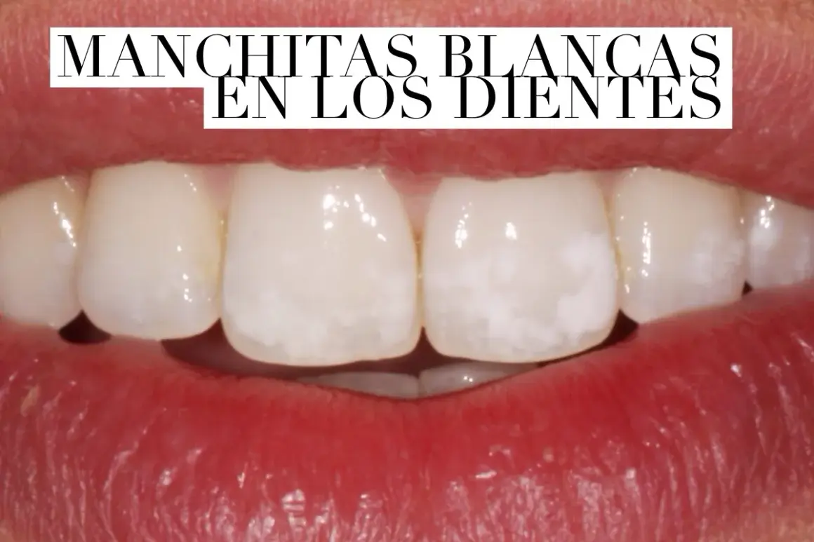 Primer plano de una boca mostrando dientes con manchas blancas.