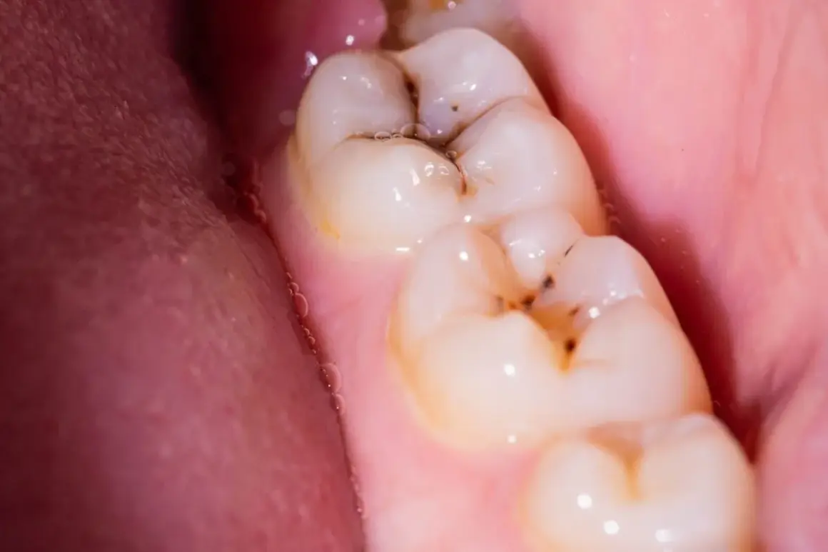 Muelas con caries y empastes. Se observa una muela picada con restos de comida y un empaste dental.