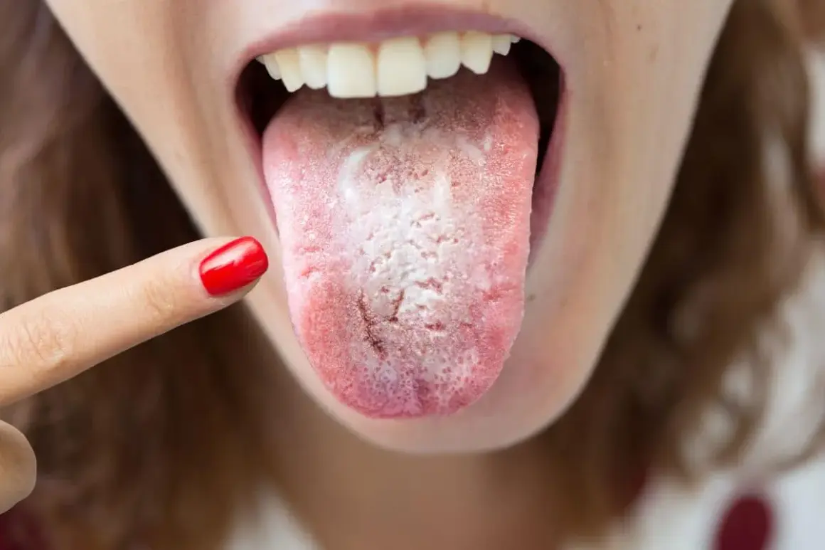Dedo con uña roja señala una lengua con una llaga blanca, indicando posible candidiasis oral.