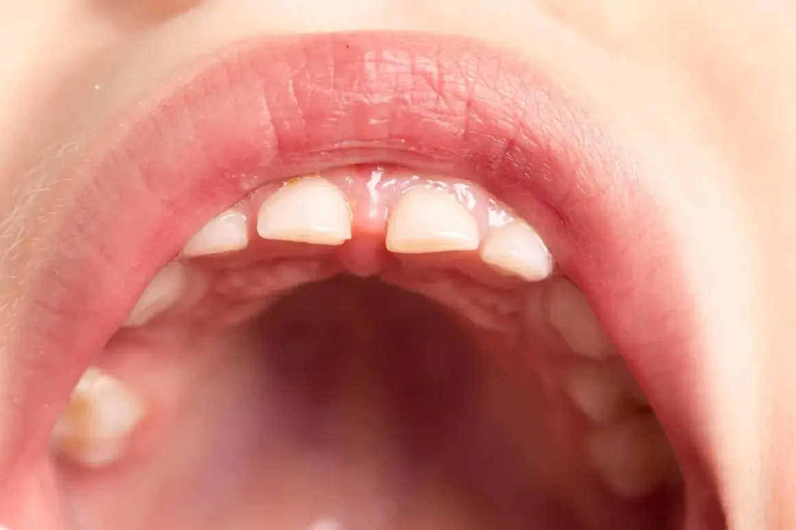 Boca de niño con dientes frontales que muestran signos de hipocalcificación del esmalte, con un aspecto opaco y ligeramente amarillento.