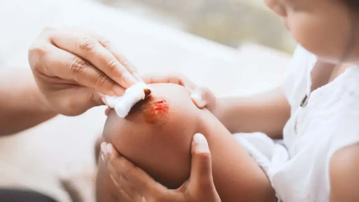 Mano limpia una herida en la rodilla de un niño con clorhexidina, cuidando las pequeñas lesiones.