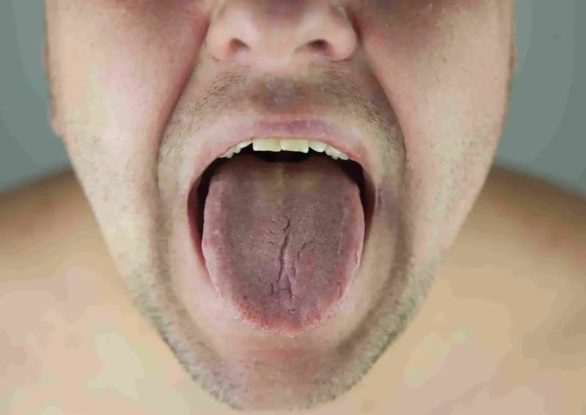 Primer plano de una boca abierta mostrando una lengua con placas y grietas.