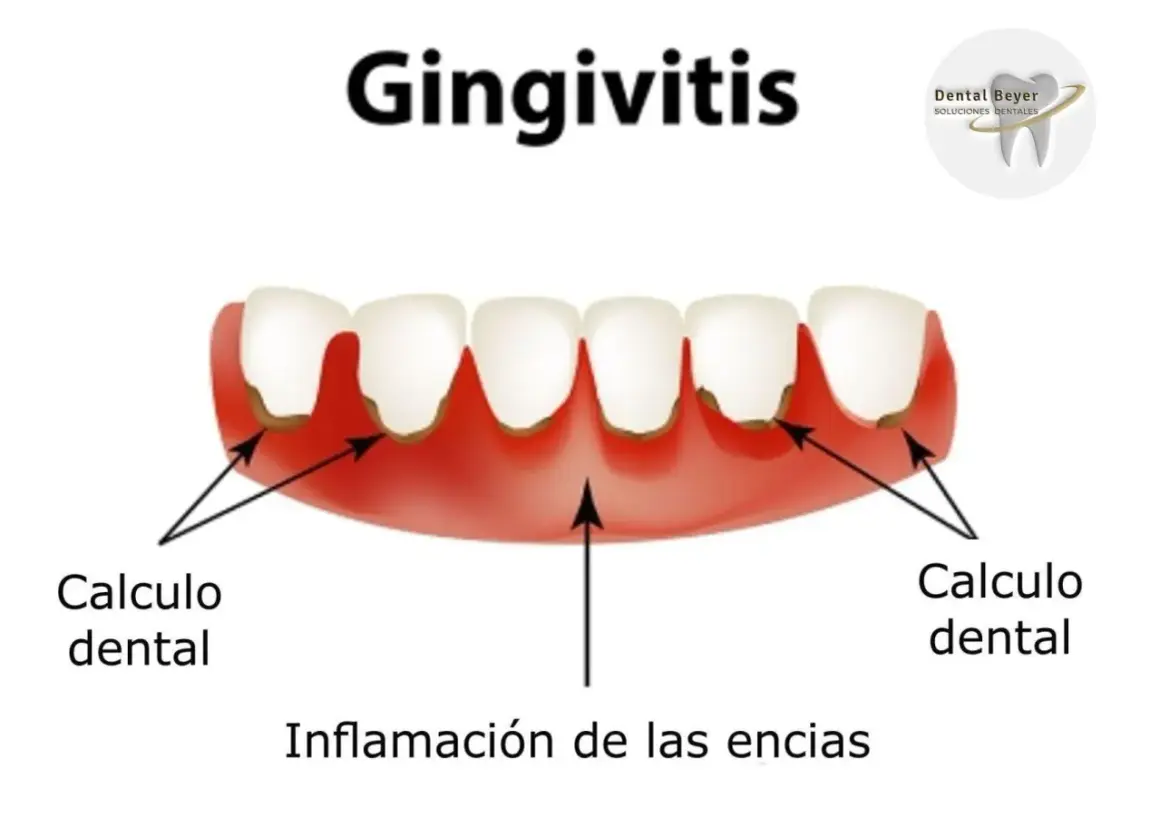 Ilustración de gingivitis con cálculo dental y encias muy inflamadas.
