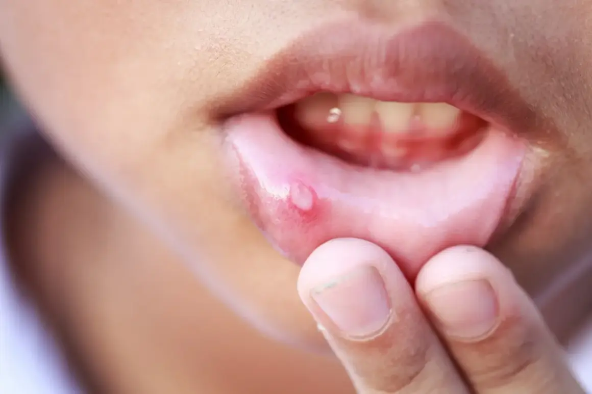 Una llaga en el labio, que puede ser contagiosa, se muestra de cerca.