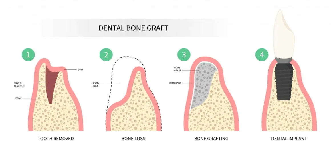 Ilustración del proceso de injerto óseo dental: extracción, pérdida ósea, injerto y colocación de implante para recuperar hueso dental.