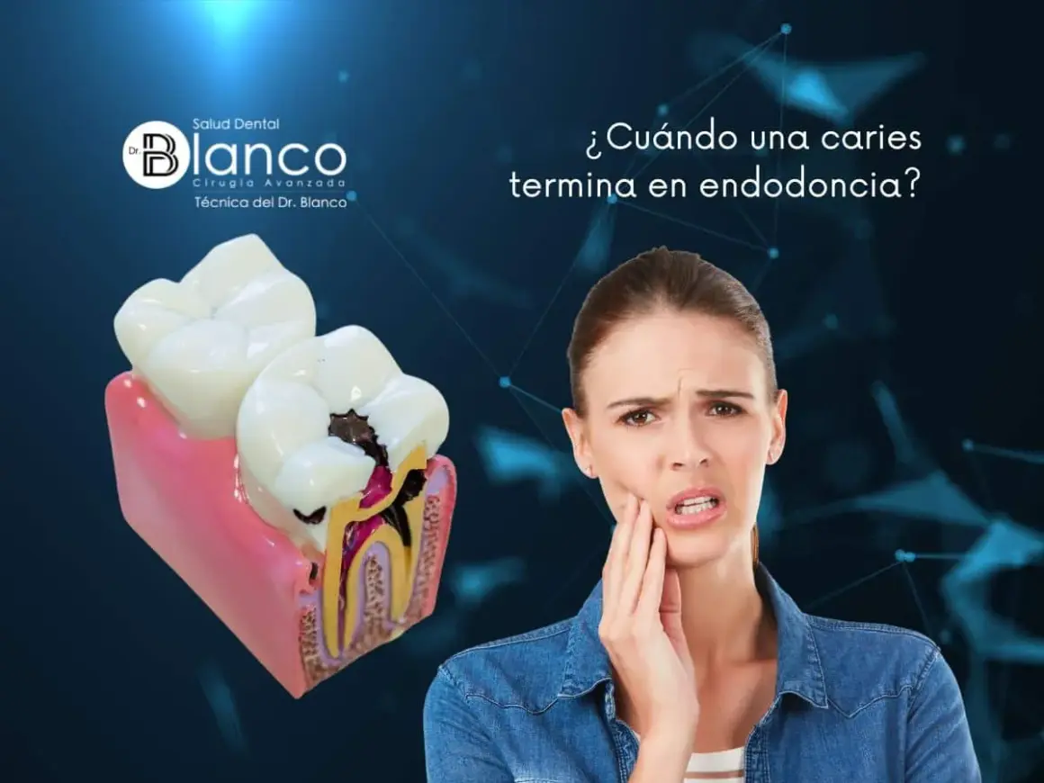 Una mujer con dolor de muelas mira un modelo dental que muestra una caries profunda. ¿Qué pasa si una caries llega al nervio?