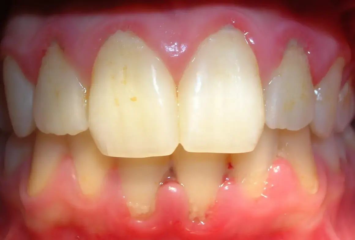 Encías inflamadas y enrojecidas, con signos de gingivitis por estrés. Se observan dientes con manchas y la línea de la encía retraída en algunas zonas.