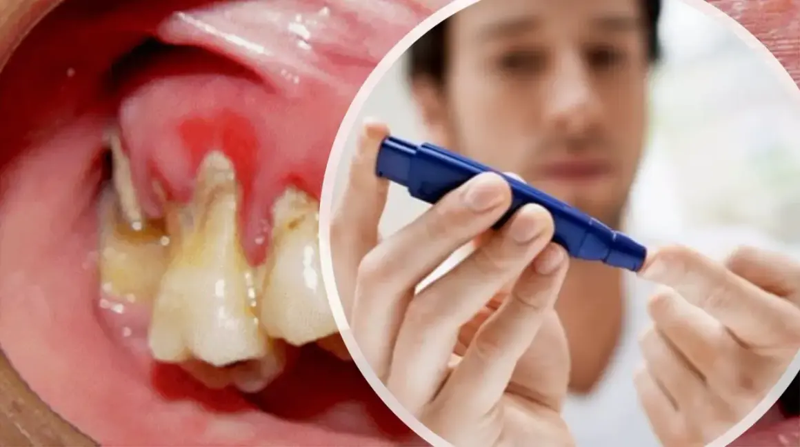 Dientes con caries y encías inflamadas, junto a un hombre midiéndose el azúcar. La diabetes puede empeorar la salud bucal.