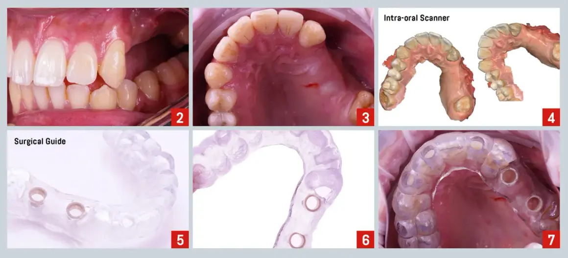Guía quirúrgica para implantes dentales, planificando un puente dental en los dientes delanteros.