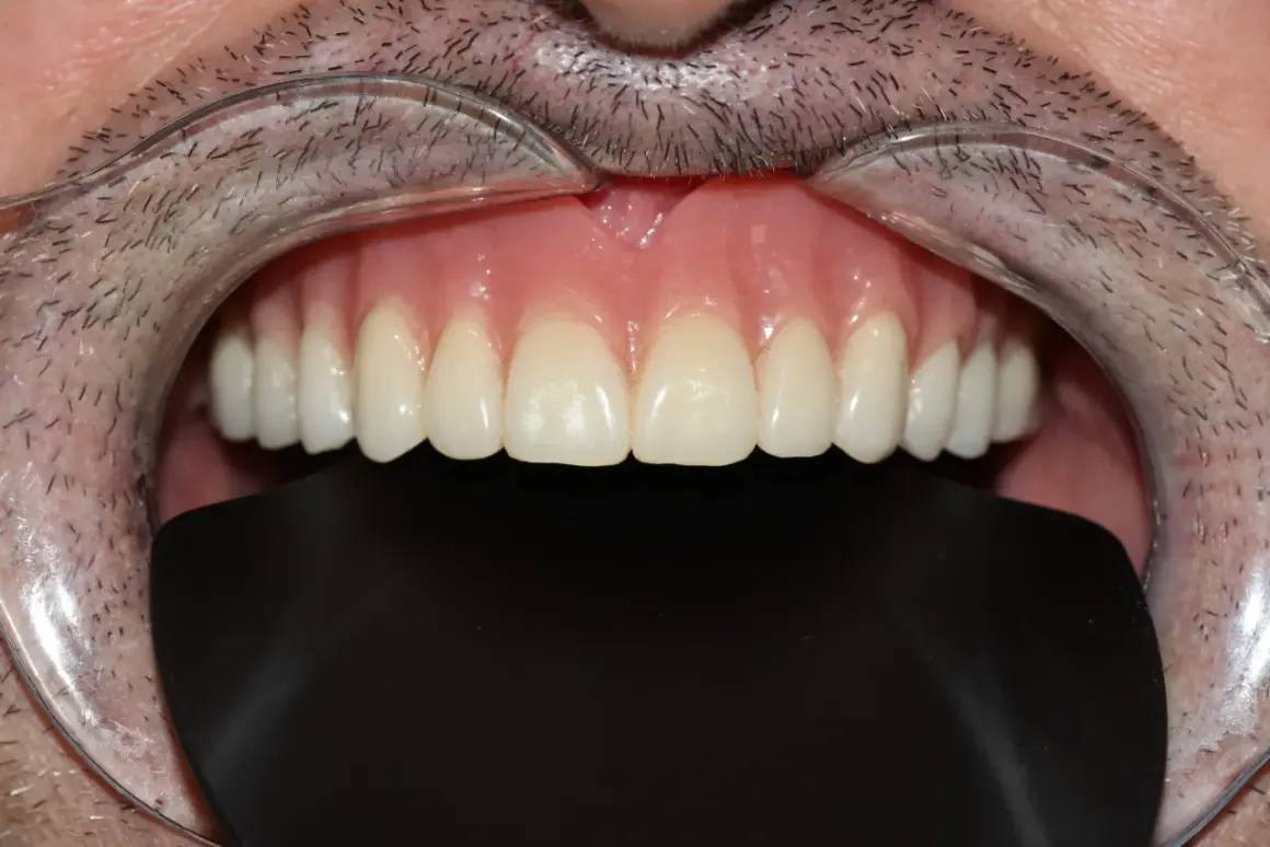 Una dentadura sin dientes, con encías rosadas y dientes postizos blancos y perfectos, se muestra en primer plano.