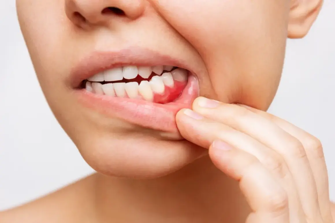 Encía inflamada y enrojecida, con signos de sangrado, quizás por el uso incorrecto del hilo dental.