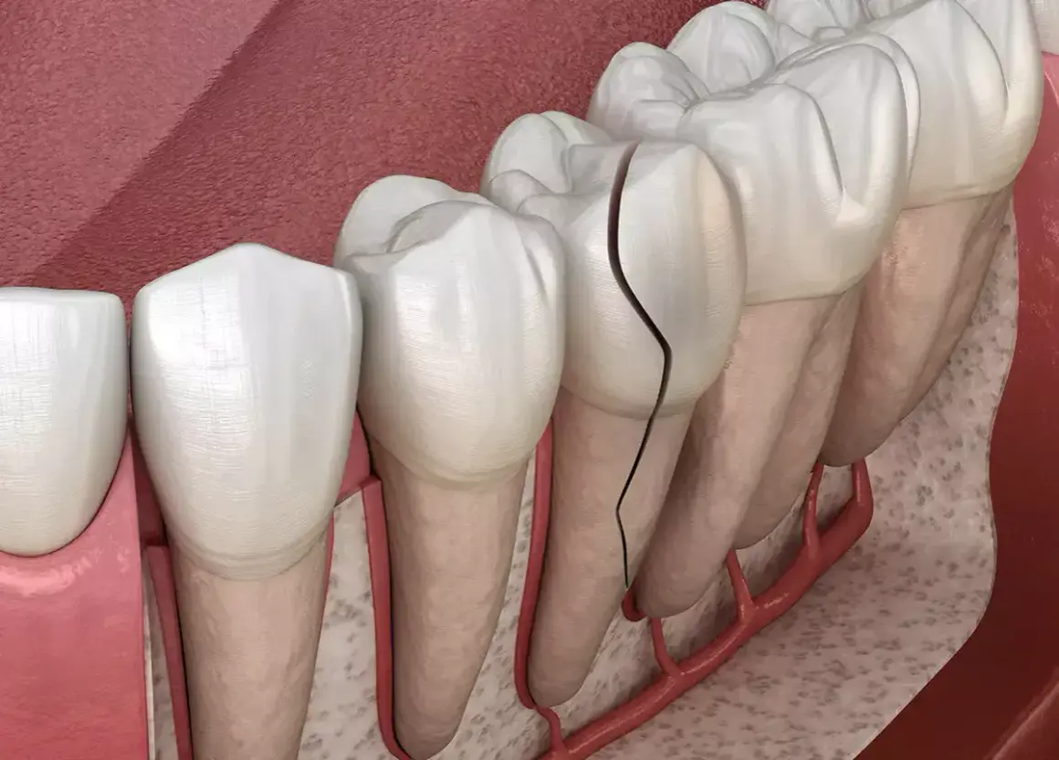 Dientes delanteros con grietas visibles, mostrando el daño en el esmalte y la pulpa.