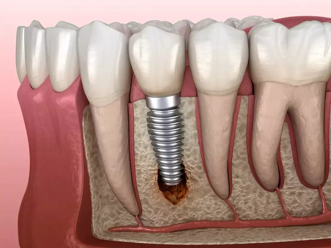 Ilustración de un implante dental con bolsas inflamatorias alrededor, mostrando la pérdida ósea y la irritación de los tejidos.