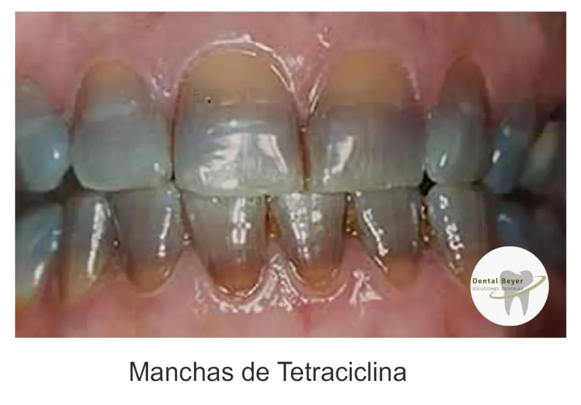 Dientes con manchas verdes y amarillas, indicativo de manchas de tetraciclina.