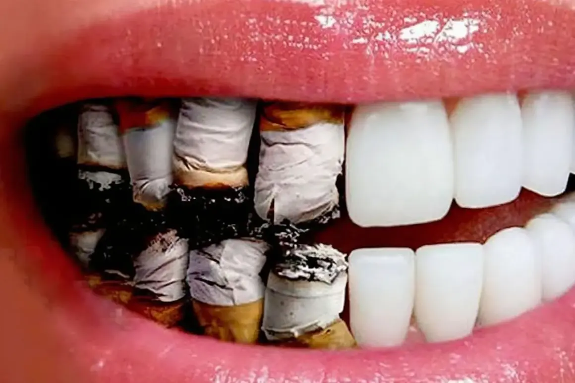 Dientes amarillentos y dañados por el efecto negativo del tabaco en nuestros dientes.