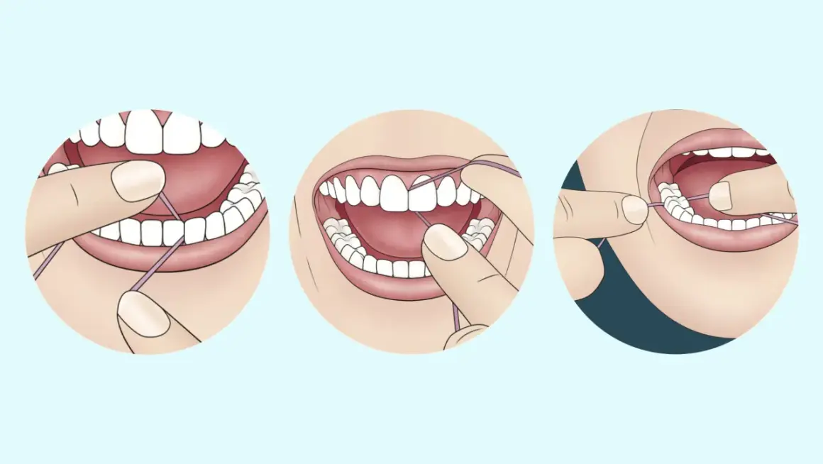 Ilustración muestra cómo usar hilo dental para limpiar entre los dientes. El hilo dental para que sirve es eliminar restos de comida y placa.