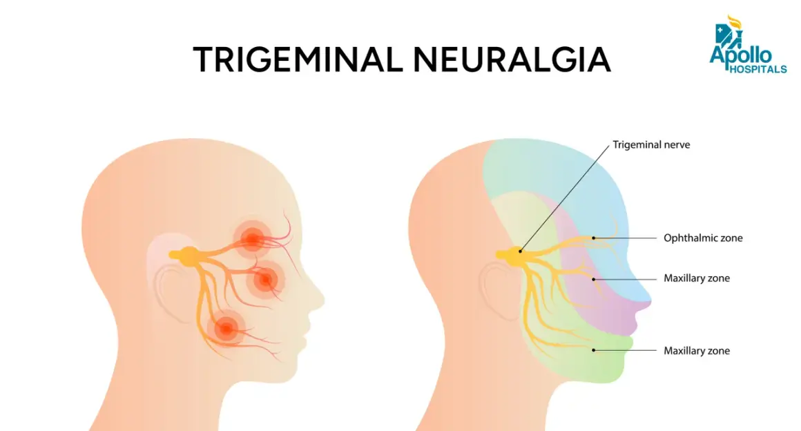 Ilustración muestra el nervio de la boca y sus zonas de afectación en la neuralgia trigeminal, con puntos de dolor en la cara.