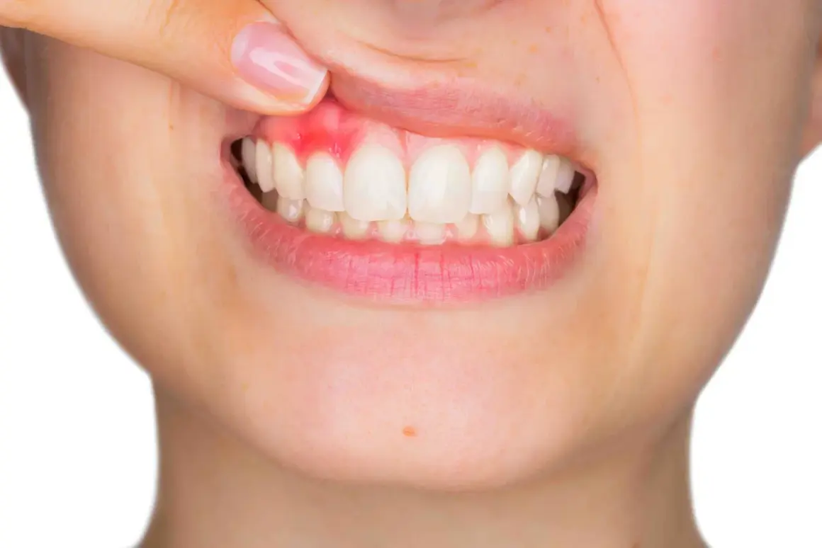 Dedo revela encía gingival inflamada y enrojecida alrededor de dientes blancos.