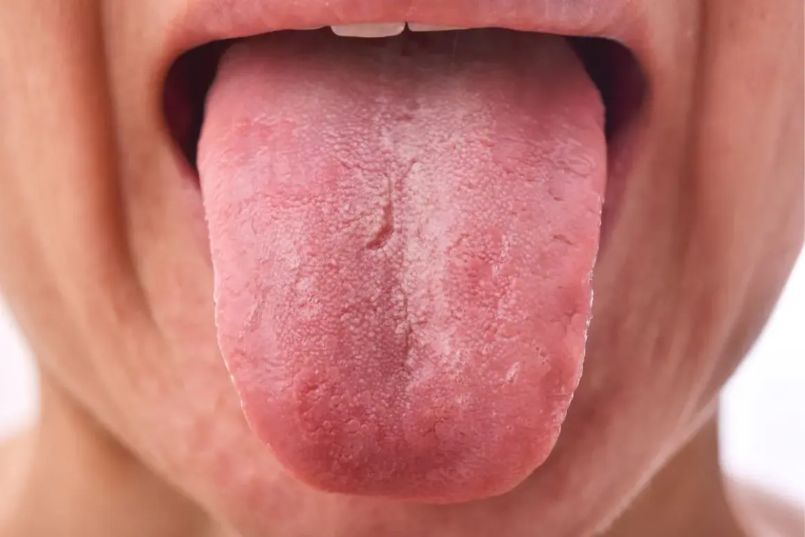 Lengua rosada con una capa blanquecina, posiblemente por uso de clorhexidina.