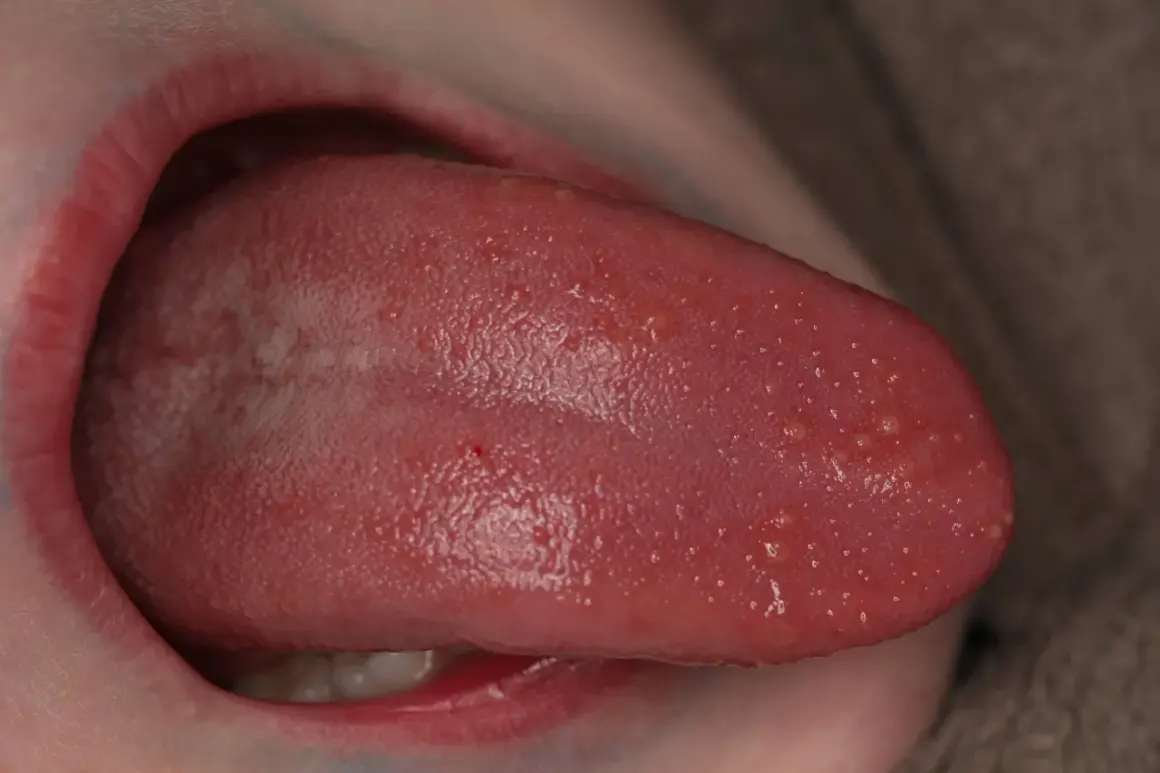 Lengua rosada con múltiples ampollas pequeñas y blancas, algunas rojas, visibles en la superficie.