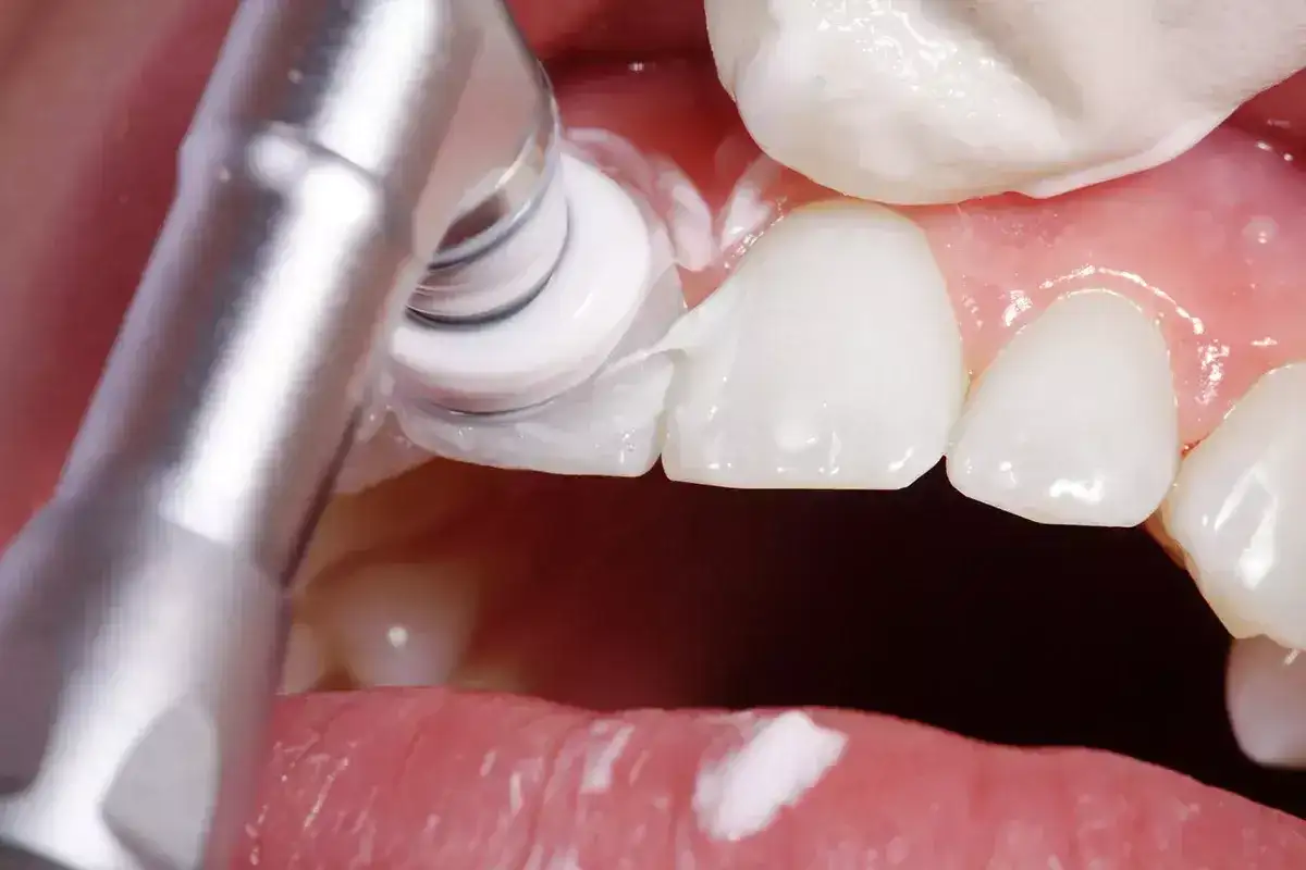 Caries en arcada superior - ¿Cómo prevenirla y tratarla?