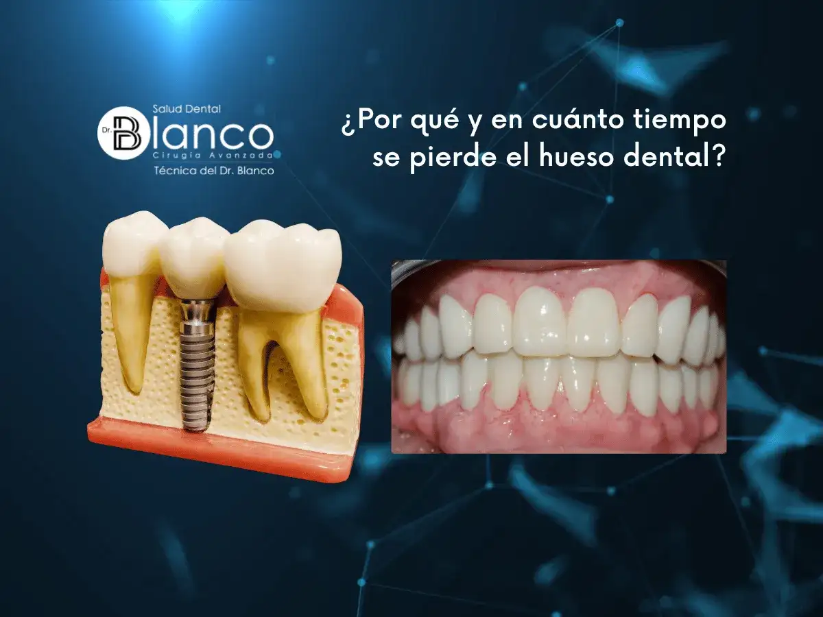 Recuperar hueso en encías - ¿Es posible? Guía completa