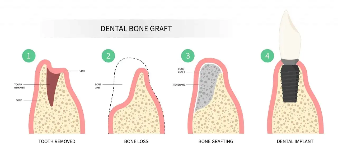 Regeneración ósea dental - Guía completa para implantes