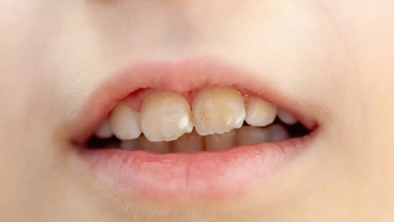Fluorosis dental en niños - manchas, prevención y tratamiento