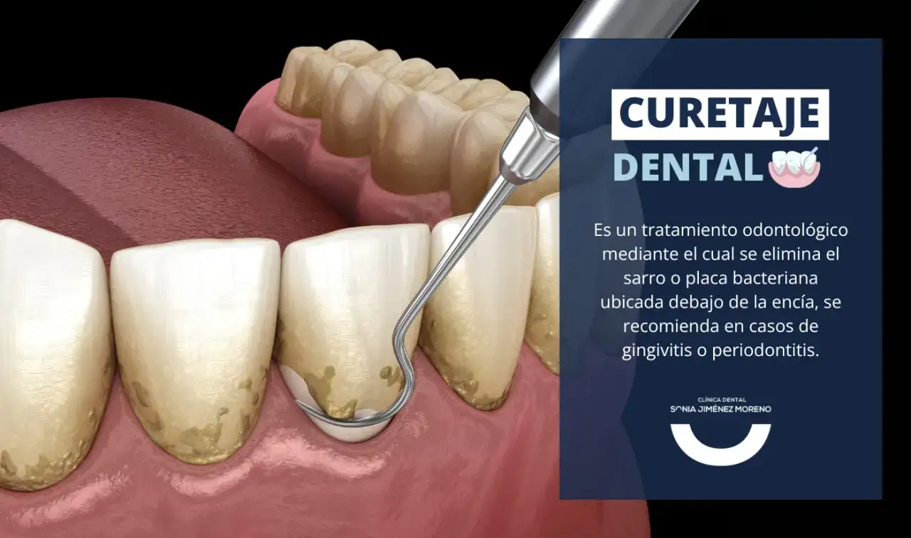 Curetaje dental, cuándo se necesita y cuánto cuesta