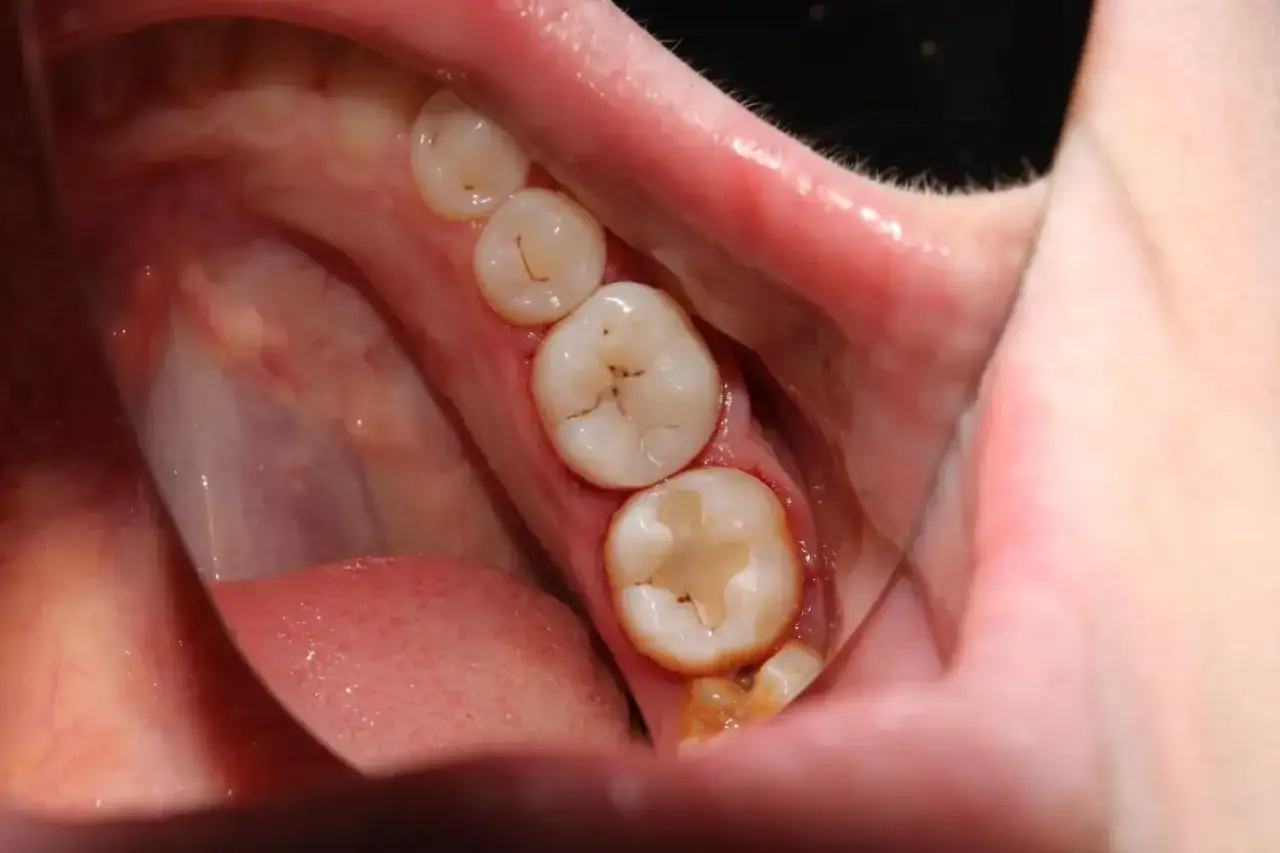 Caries - ¿Por qué aparecen y cómo frenarlas de verdad?