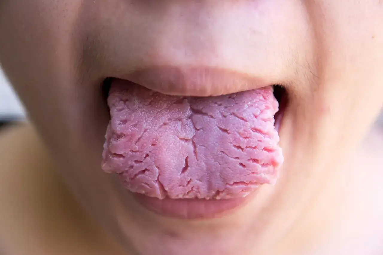 Lengua rosada con surcos profundos y aspecto rugoso, similar a llagas rojas en la lengua.