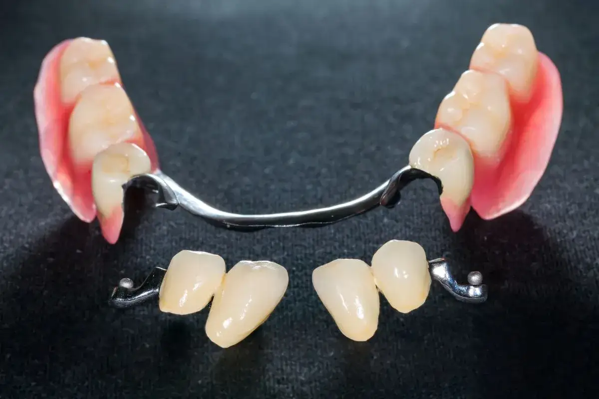 Pr&oacute;tesis dental con dientes de porcelana y estructura met&aacute;lica.