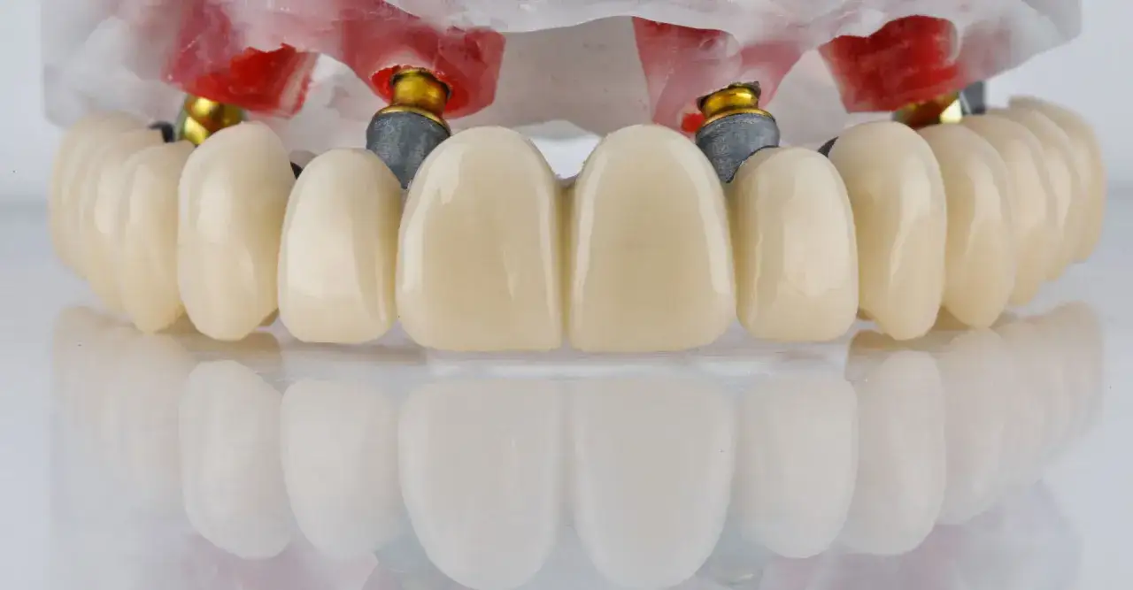 Prótesis dental sobre implantes, una dentadura sin dientes que devuelve la sonrisa.