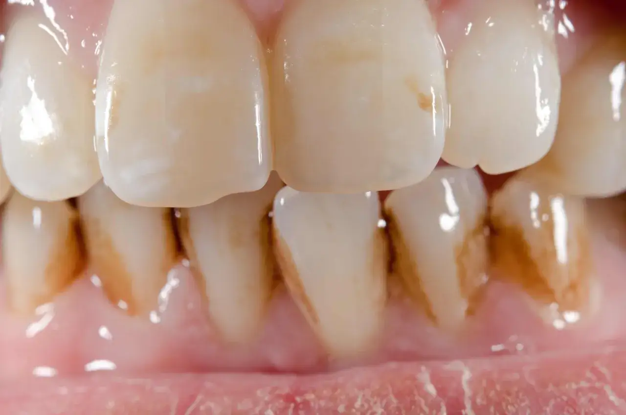 Primer plano de dientes con manchas marrones en las muelas que no son caries, indicando posible acumulación de sarro o pigmentación.