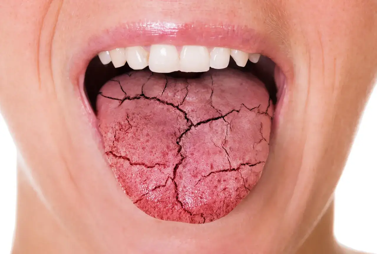 Lengua agrietada, síntoma de diabetes y riesgo de caries.