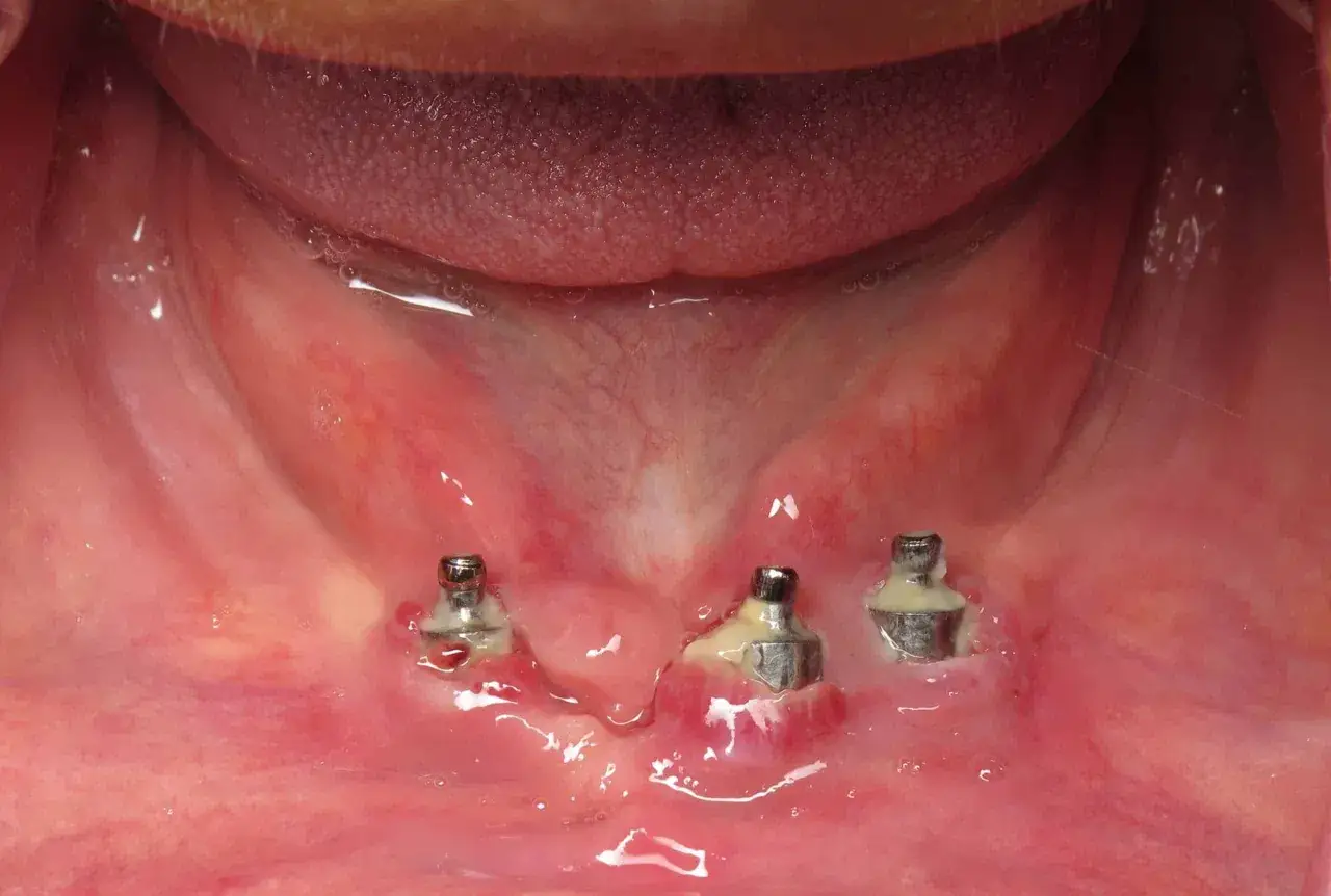 Enc&iacute;a enrojecida y con hinchaz&oacute;n alrededor de los implantes dentales, indicando posibles bolsas inflamatorias.