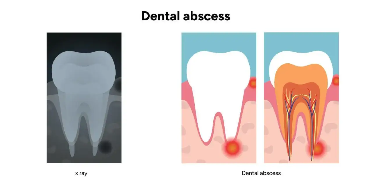 Radiografía de un diente y diagrama de un absceso dental, mostrando la inflamación y pus porque sale un flemon en la encia.
