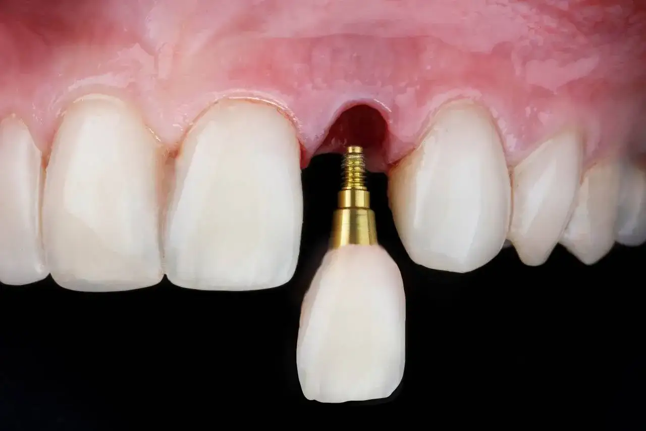 Un implante dental dorado con su corona lista para ser colocada en la encía, entre dientes blancos.