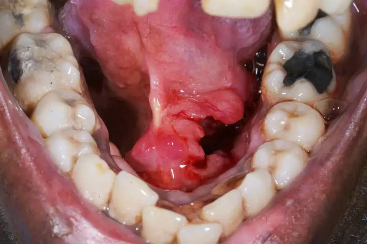 Lesión rojiza y abultada en la boca, con aspecto de ampolla debajo de la lengua, rodeada de dientes con caries.