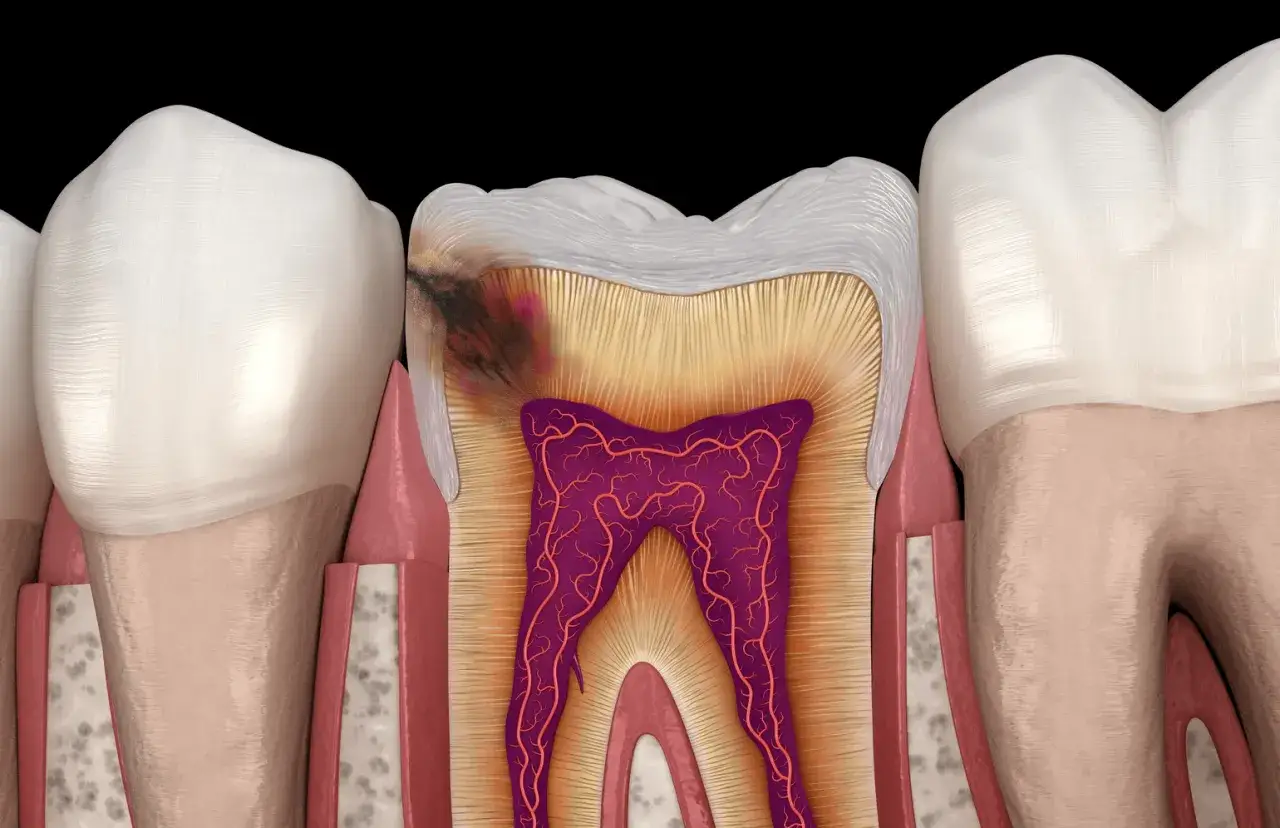Corte de dientes mostrando caries en las caras interproximales y la pulpa dental.