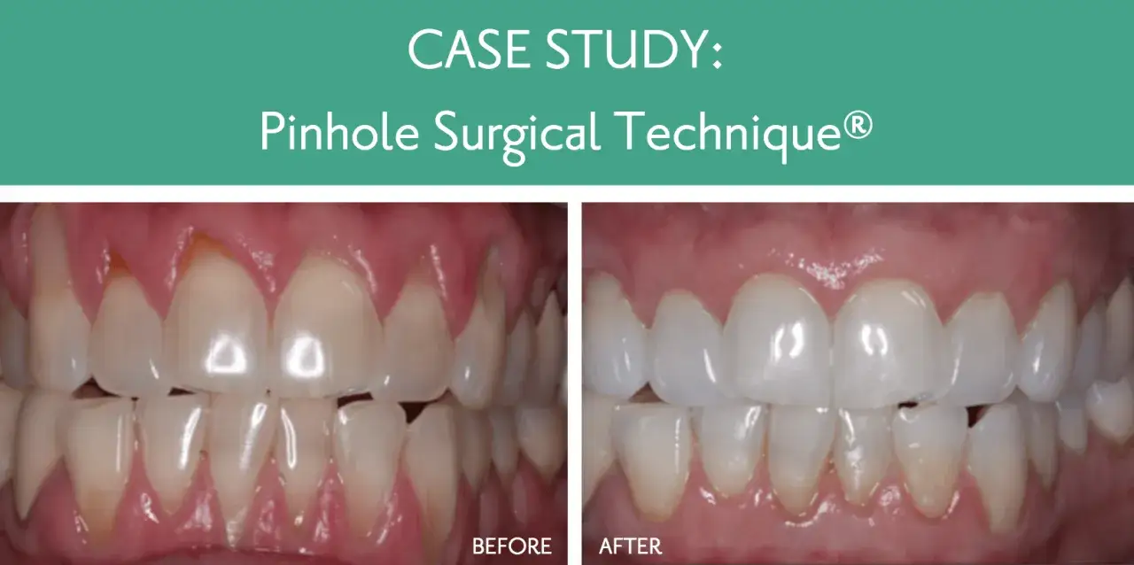 Antes y después de tratar poner encías retraídas con la técnica Pinhole. Las encías lucen más sanas y cubren mejor los dientes.
