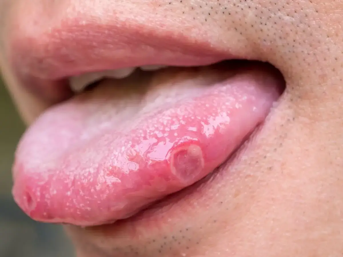 Lengua con ampollas dolorosas, mostrando úlceras rojas y blancas.