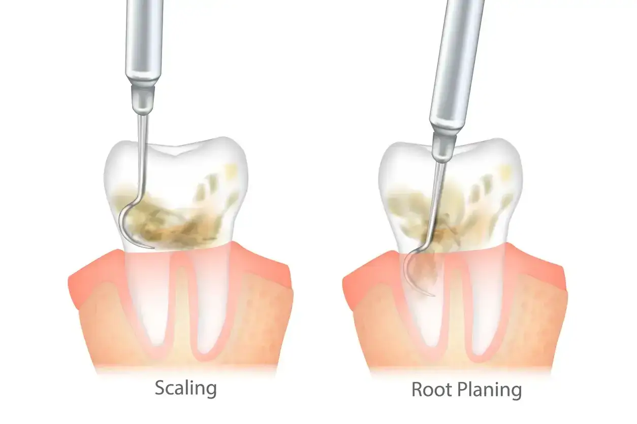 Ilustración de curetaje dental: limpieza de sarro y raspado radicular para eliminar placa y cálculo dental.