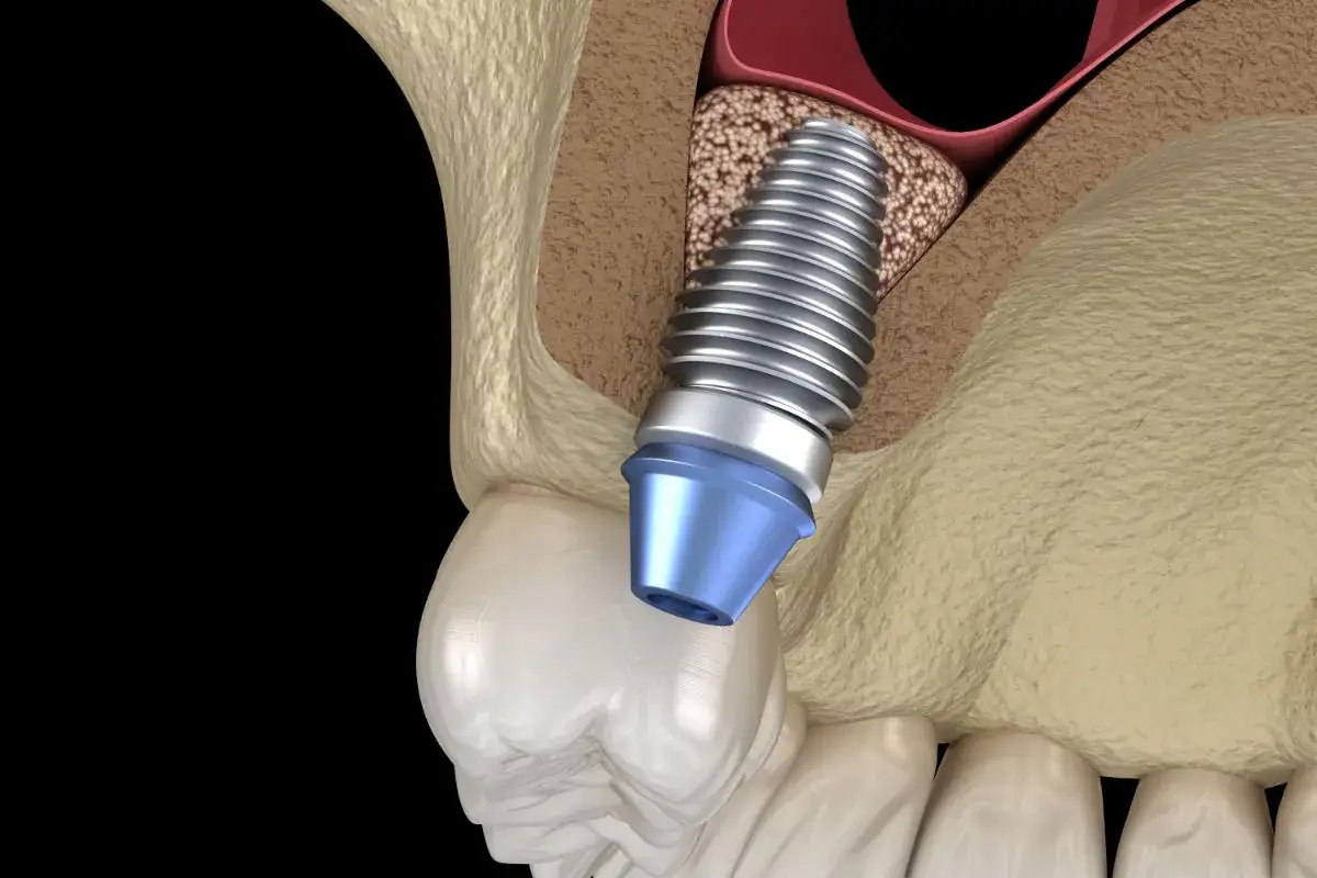 Implante dental en proceso de osteointegración, ayudando a recuperar hueso dental y dar soporte a una prótesis.