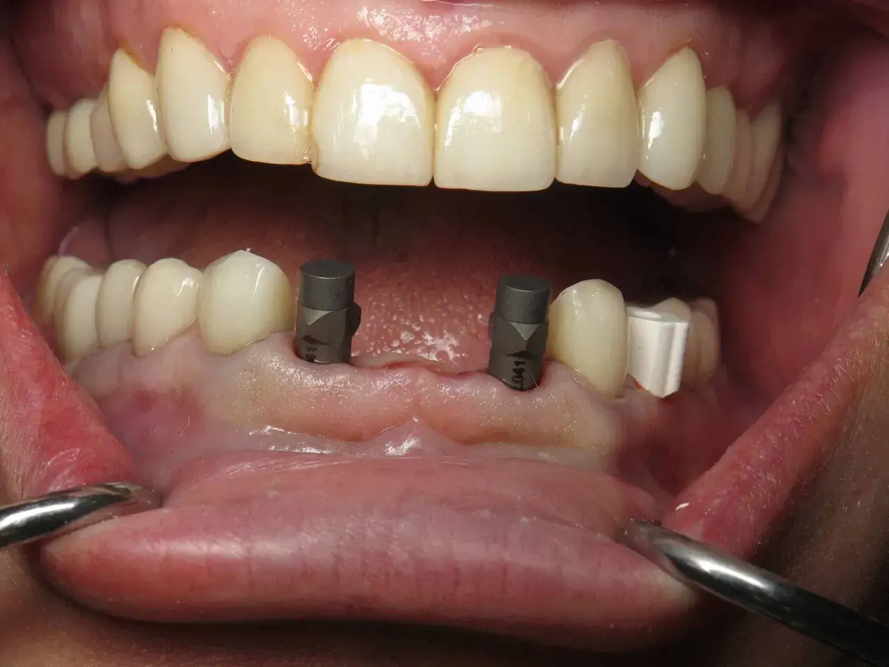 Dos implantes dentales listos para recibir un puente dental frontal.