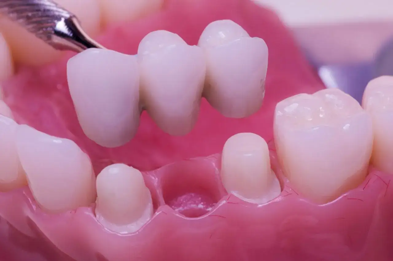 Puente dental siendo colocado. Evita el dolor en puente dental al masticar con una buena higiene.