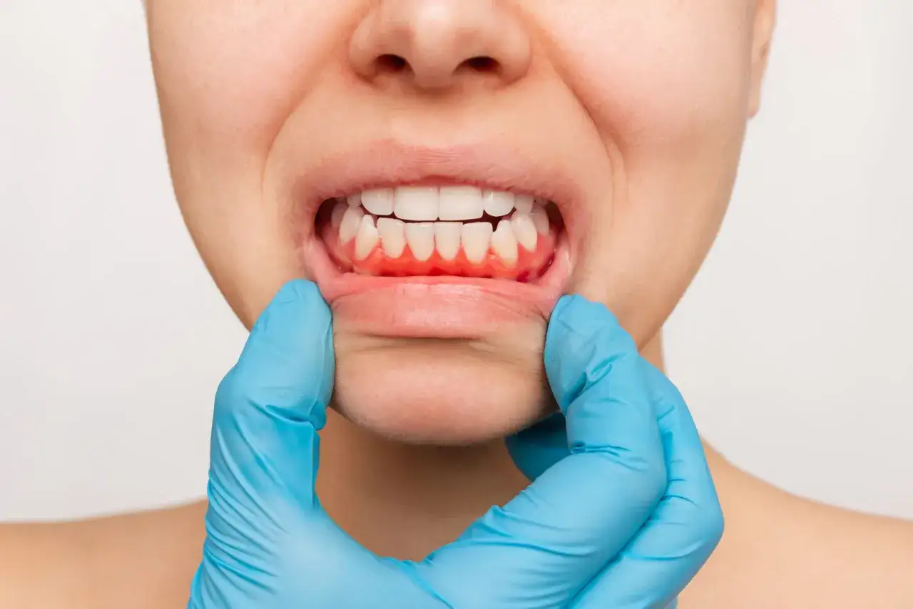 Encía inflamada y enrojecida, posible gingivitis por estrés. Un guante azul examina la boca.