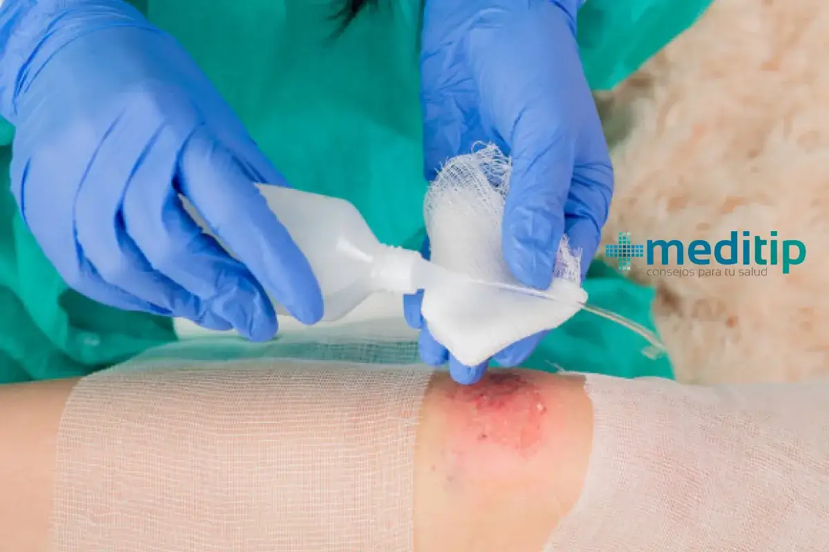 Manos enguantadas aplican solución de clorhexidina a una gasa para limpiar heridas.